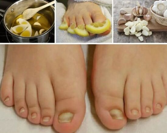 Popular remedies for the nail fungus