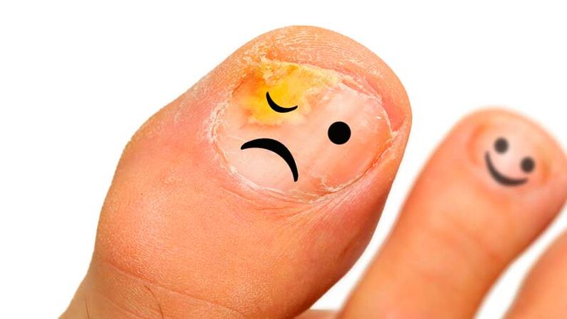 Nail fungus