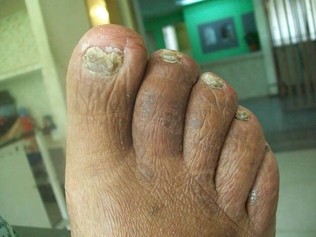 The lesion of the mushroom