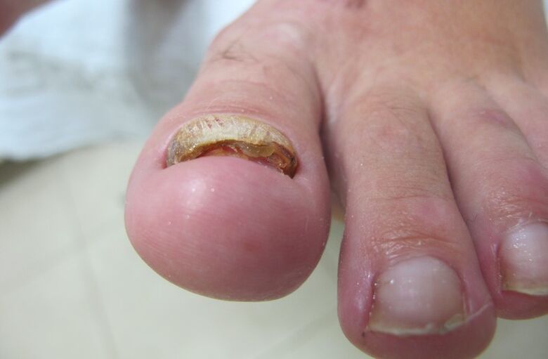 exfoliation of the nail with a running fungus