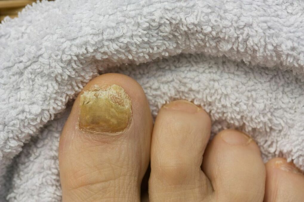 Atrophic stage of the fungus (falling off toenail pieces)