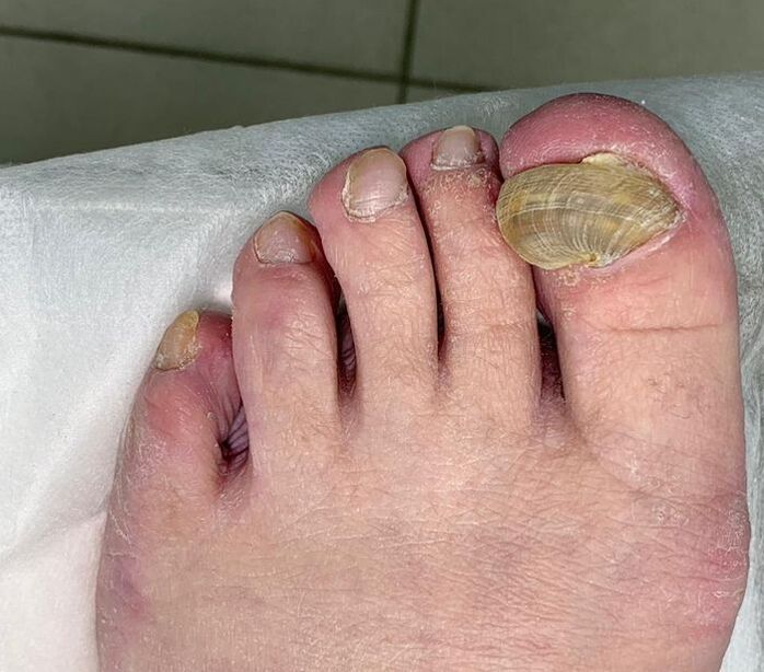 Hypertrophic onychomycosis on the leg - deformed nail