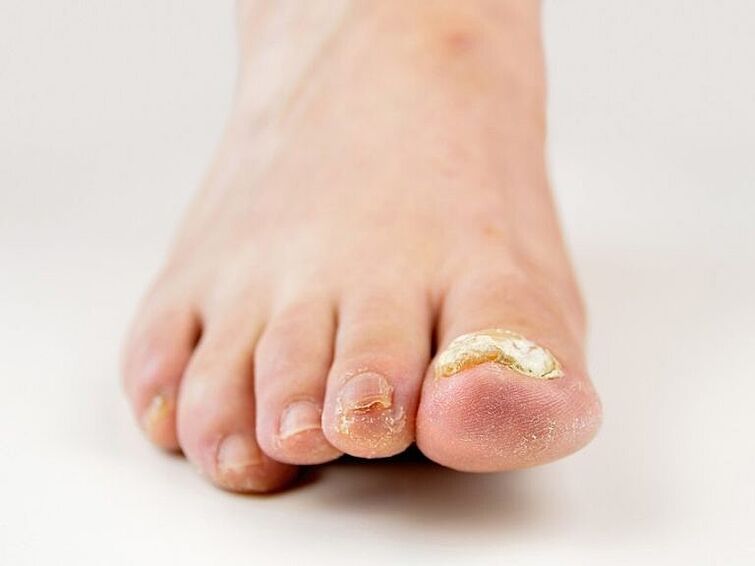 Thickening of the nail plate on the big toe with a fungus