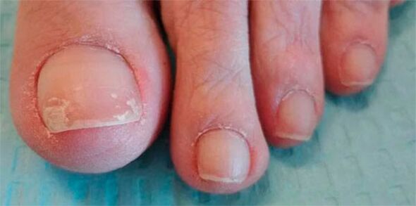 Fungal leg phase