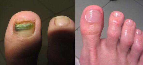Treatment of the nail fungus