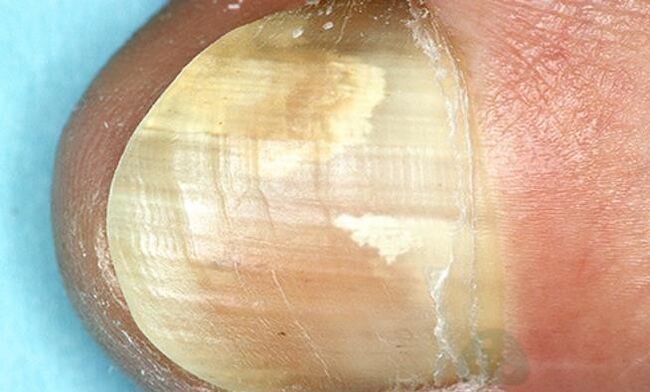 Punta mushroom treatment with internal actions drugs