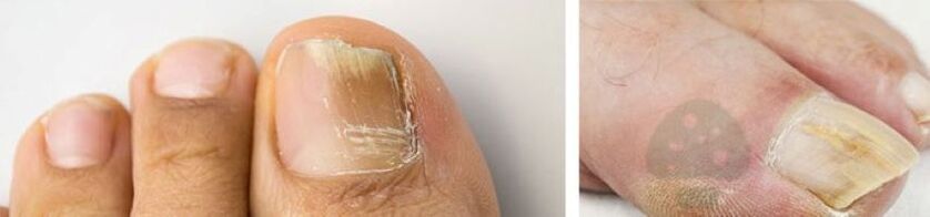 The mushroom of the thumb nails on the leg