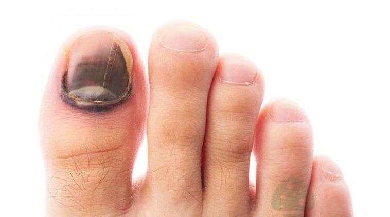 The running phase of the disease with a thumb nail mushroom