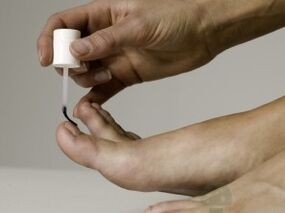 Treatment of the nail fungus