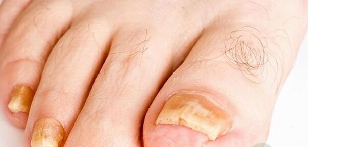 Variety of the nail fungus