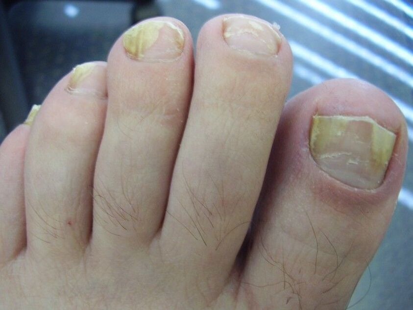 toenail fungus symptoms