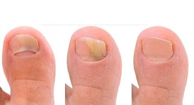 development stages of toenail fungus