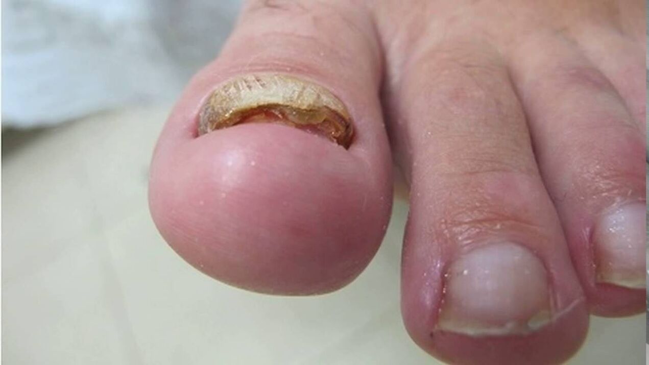 Hypertrophic fungus deformation of the edges, loss of color and thickening of the nail plate