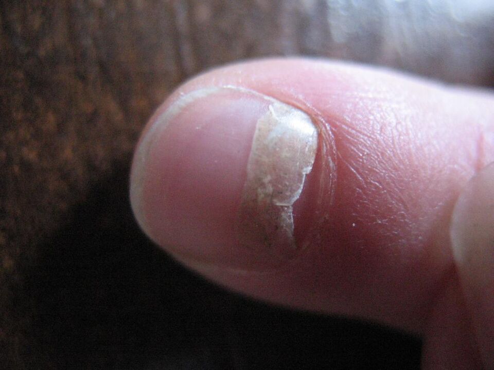 The onycholytic type of the fungus is accompanied by detachment of the nail plate