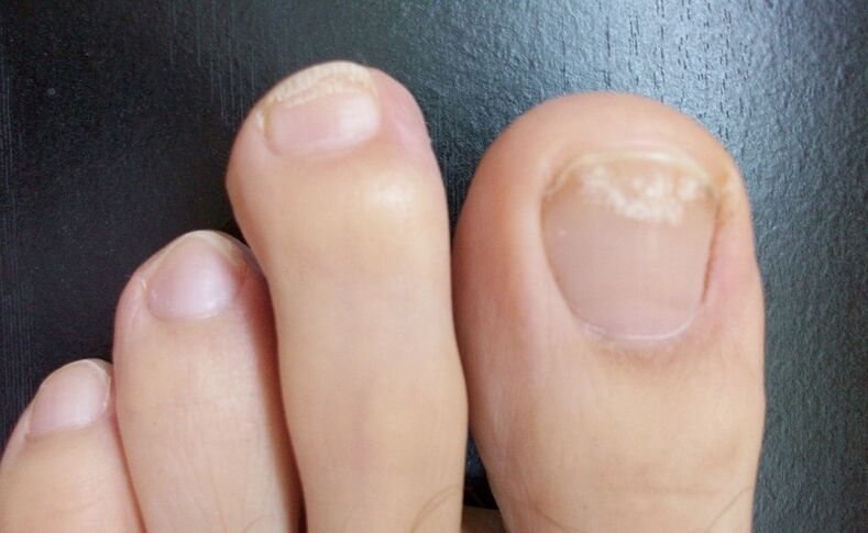 The first signs of fungus are a change in the color of the nail plate, the appearance of spots